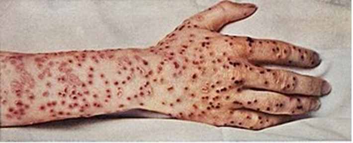 Smallpox, the worst of several diseases that struck Indigenous Americans for the first time. Image from Wikimedia Commons.