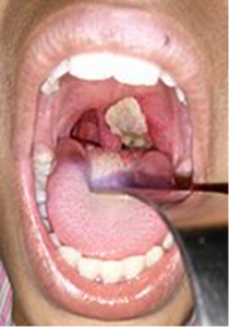 Diphtheria infection. Image from Wikimedia Commons.
